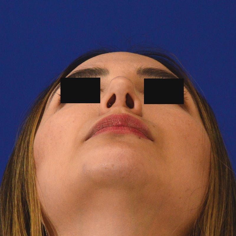 rhinoplasty patient before Beverly Hills by Dr. Torkian