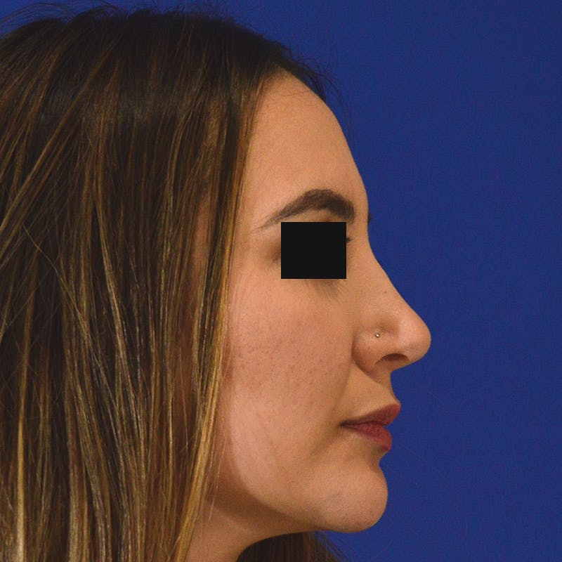 rhinoplasty patient after Beverly Hills by Dr. Torkian