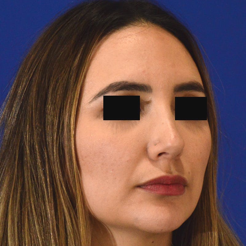 rhinoplasty patient after Beverly Hills by Dr. Torkian