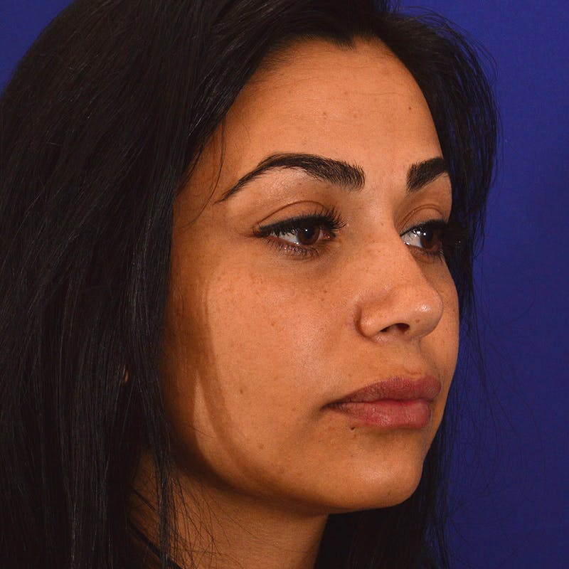 rhinoplasty patient after Beverly Hills by Dr. Torkian