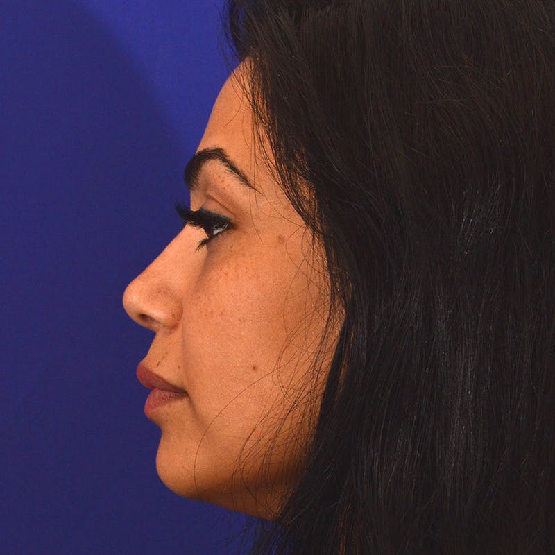 rhinoplasty patient after Beverly Hills by Dr. Torkian