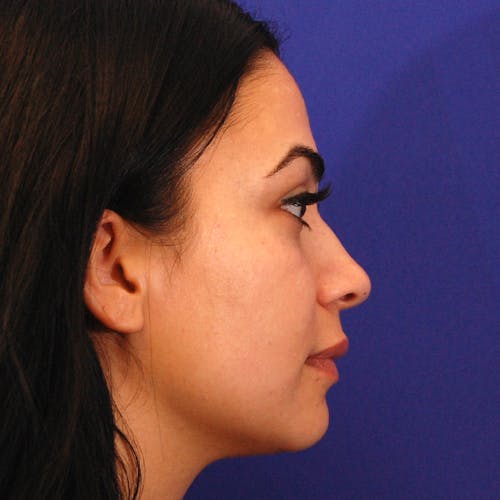 rhinoplasty patient after Beverly Hills by Dr. Torkian