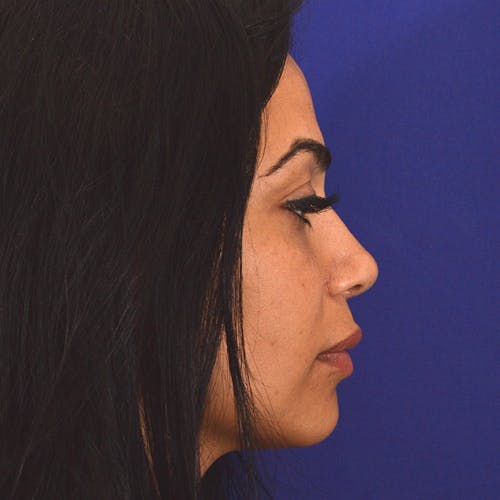 rhinoplasty patient after Beverly Hills by Dr. Torkian