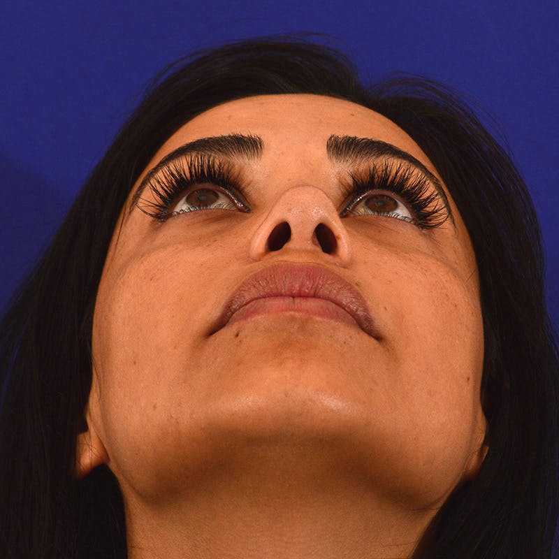 rhinoplasty patient before Beverly Hills by Dr. Torkian