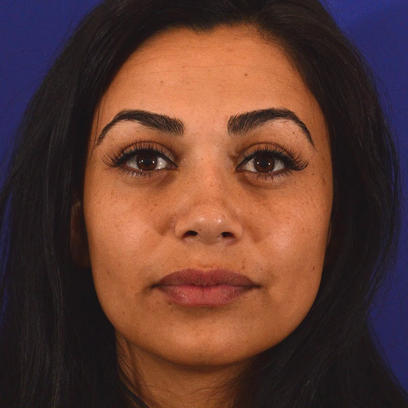 rhinoplasty patient Beverly Hills by Dr. Torkian
