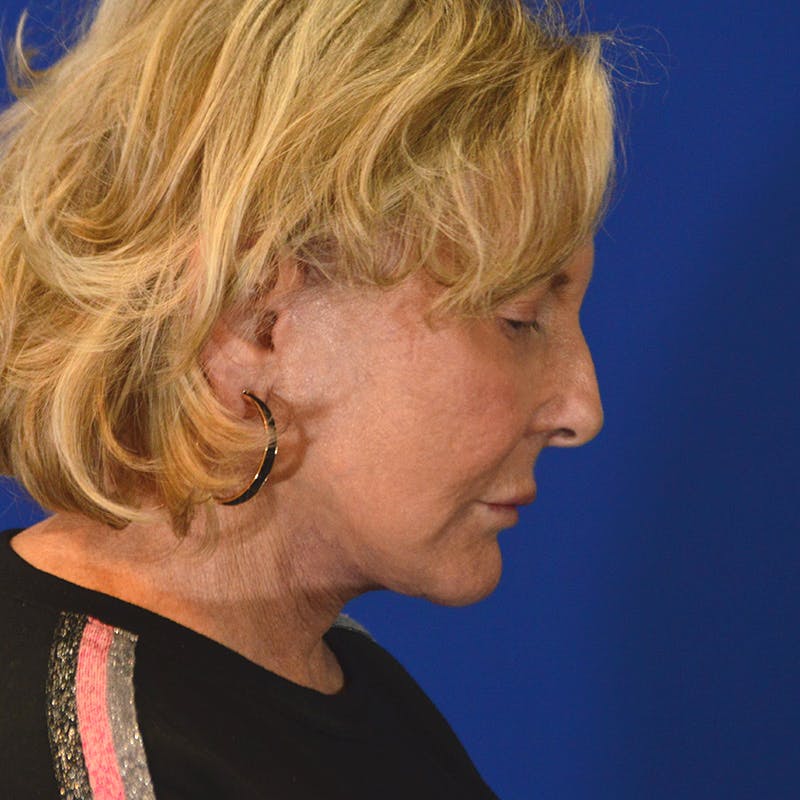 Face and Neck lift after Beverly Hills by Dr. Torkian