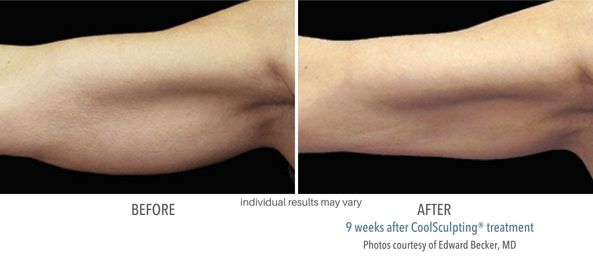 coolsculpting arm fat