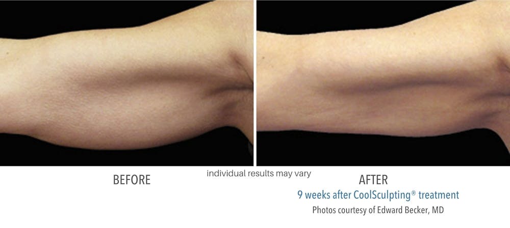 coolsculpting arm fat