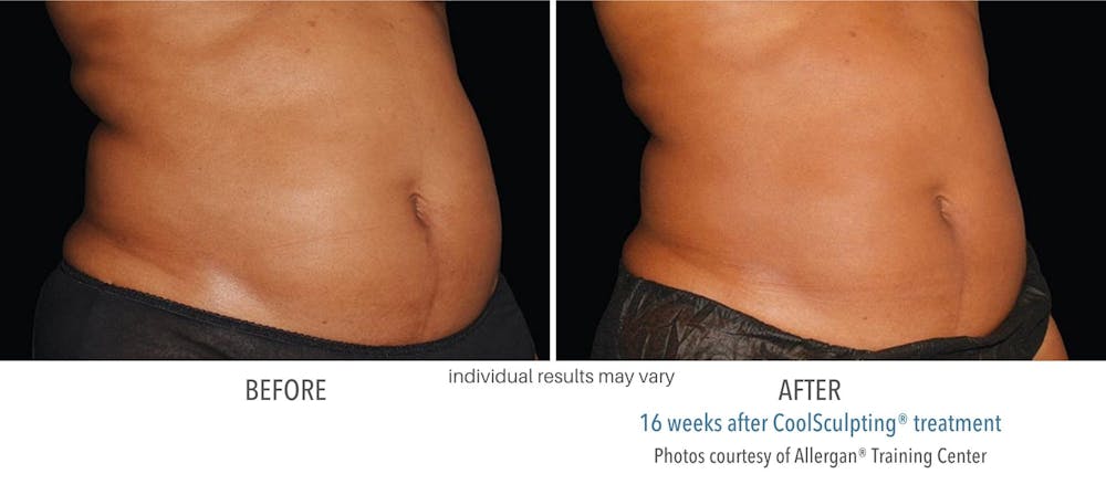 coolsculpting stomach for men