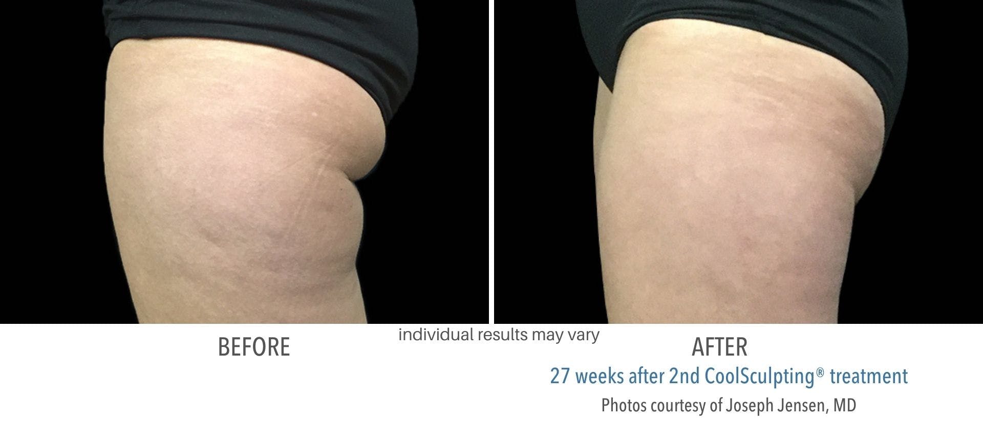 coolsculpting buttocks fat