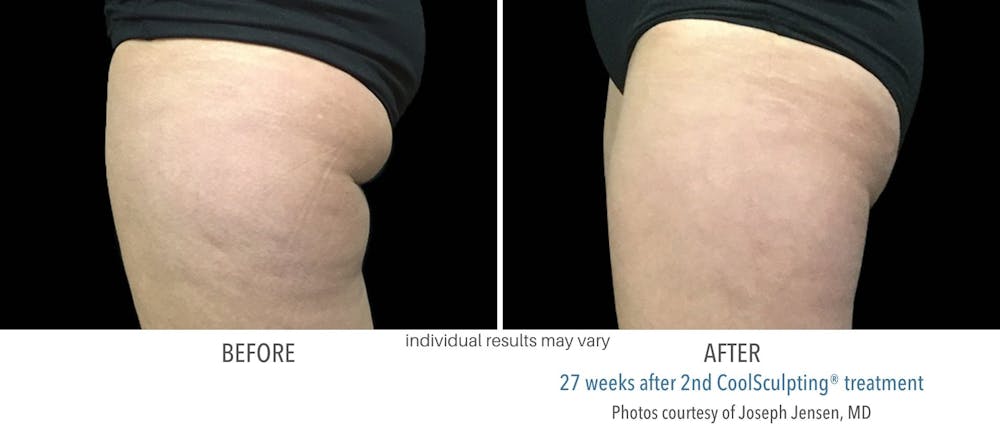 coolsculpting buttocks fat