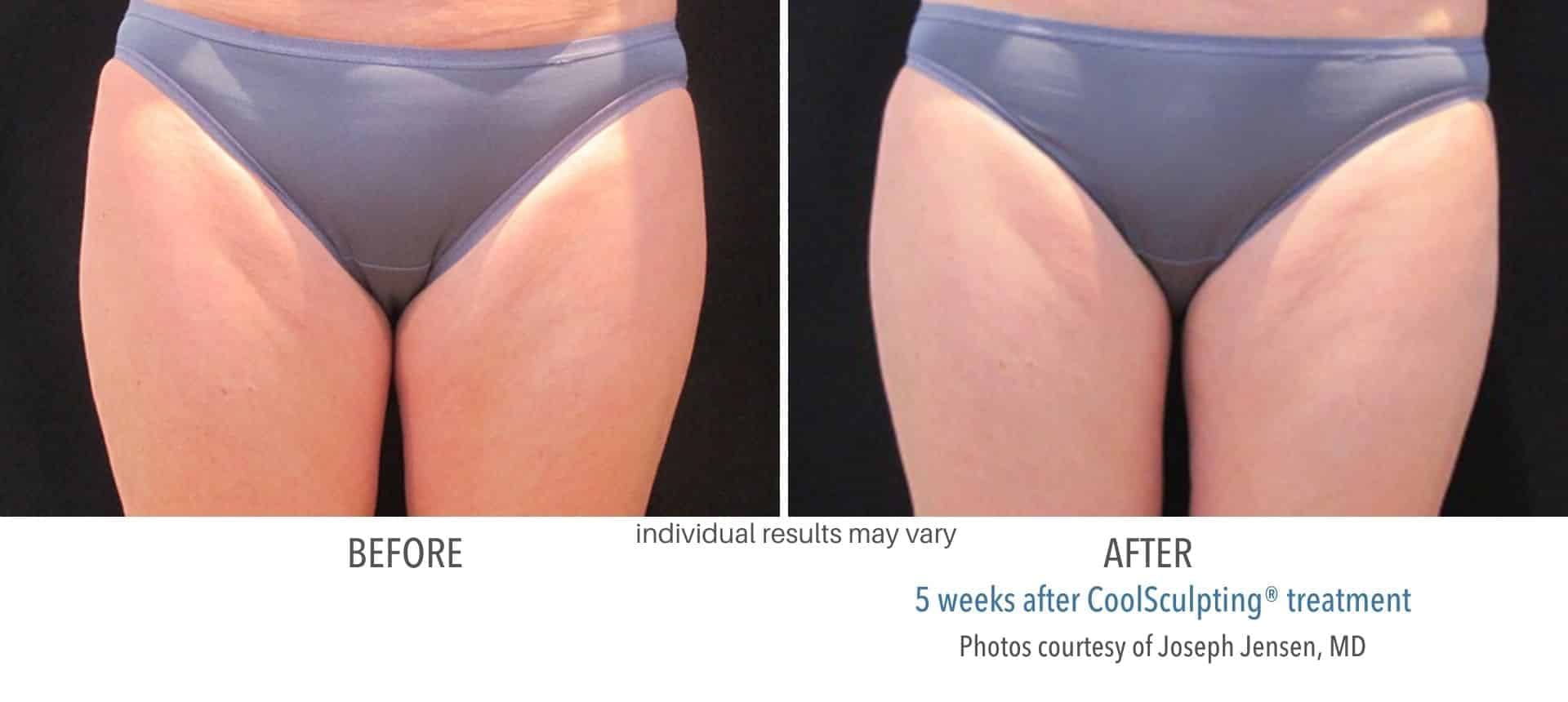 Hip fat removal without surgery with CoolSculpting