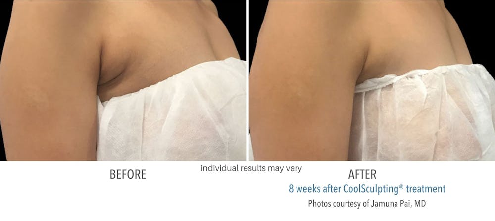 coolsculpting armpit fat