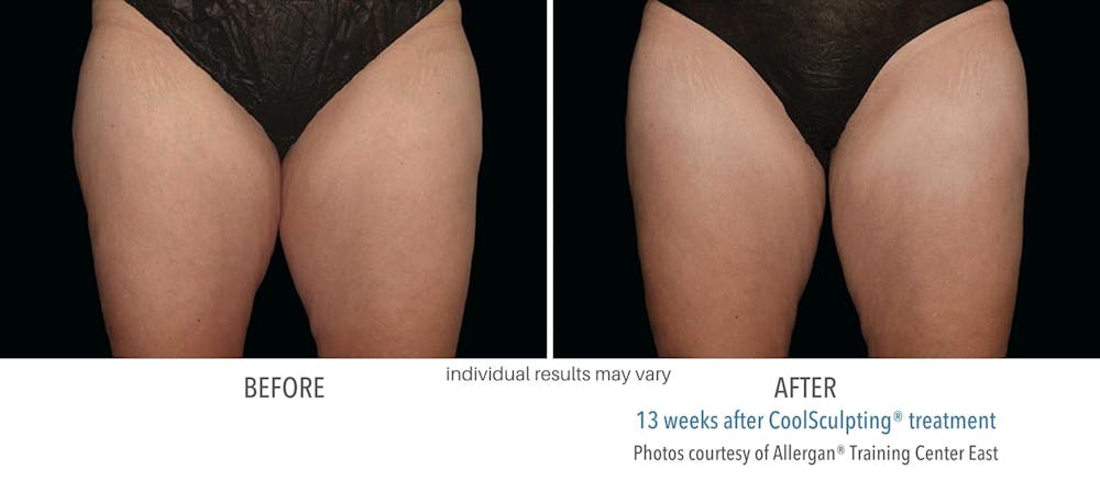 coolsculpting thighs
