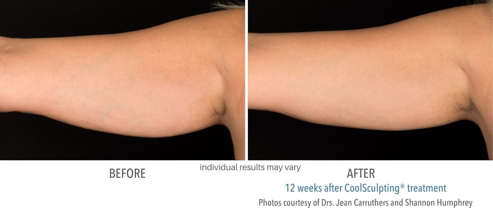 coolsculpting arm fat treatment