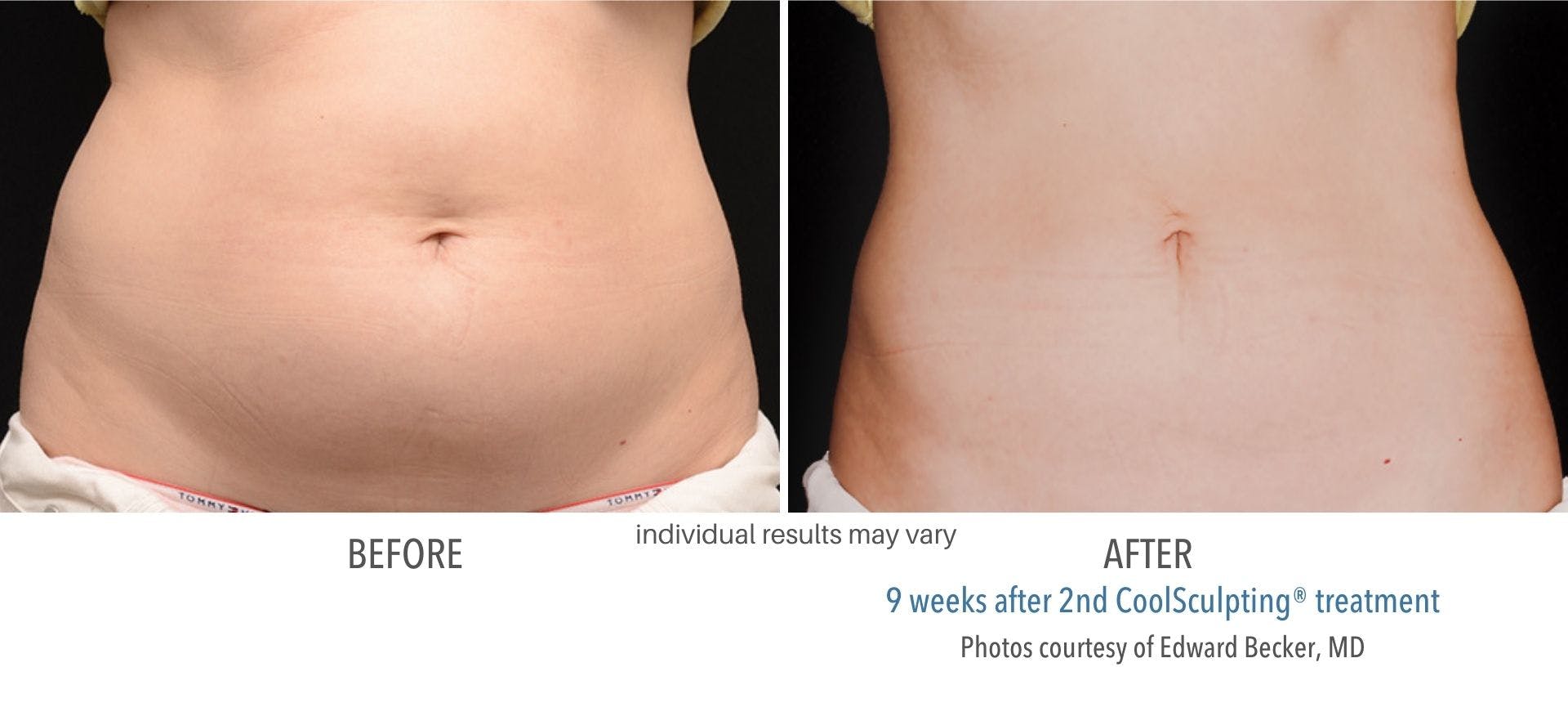 coolsculpting abdomen