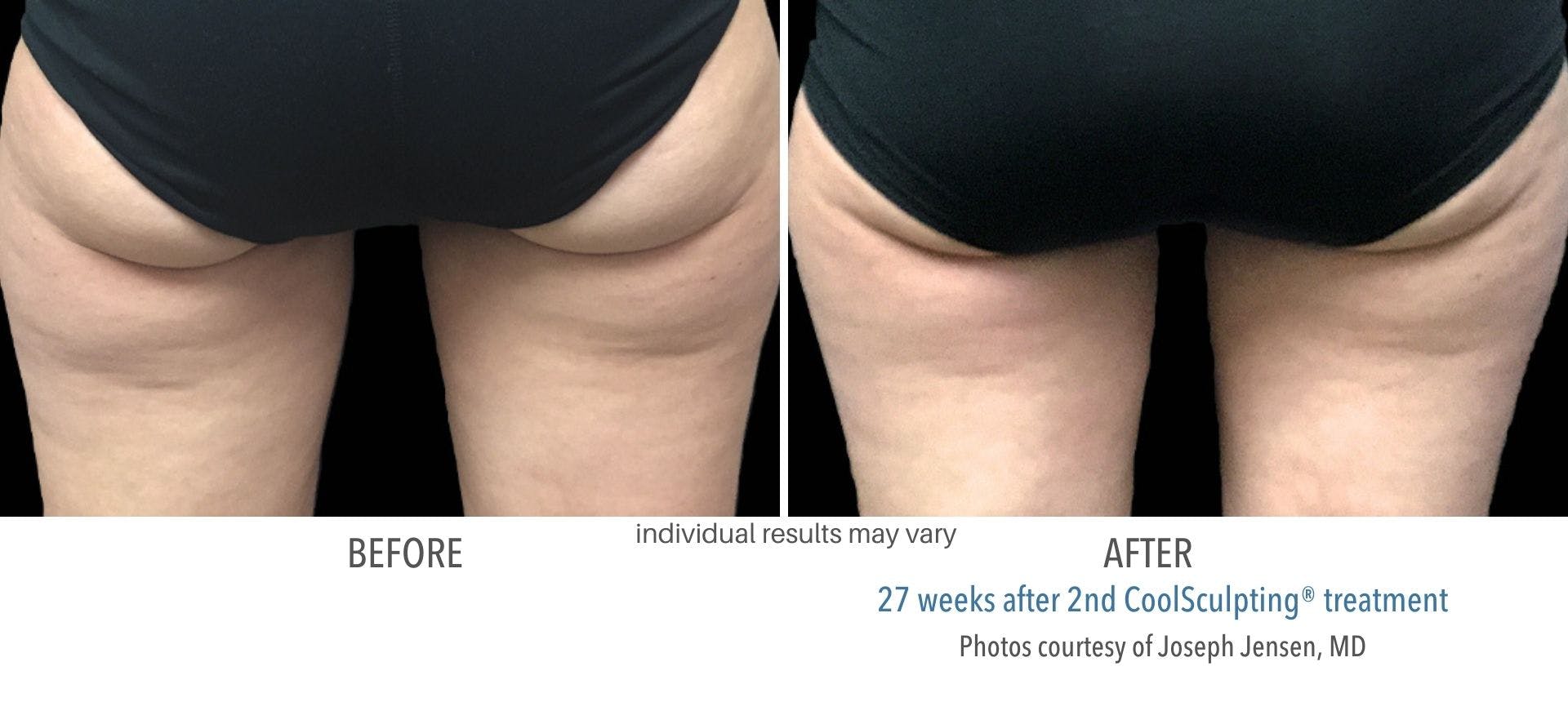 coolsculpting buttocks