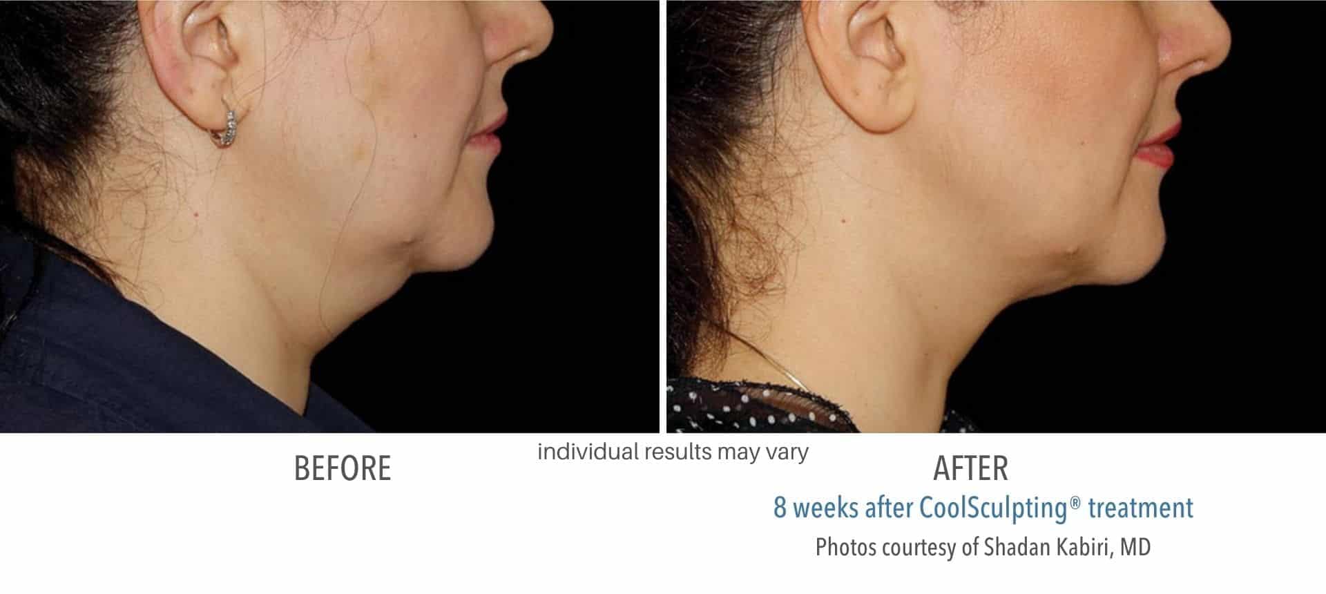 coolsculpting double chin