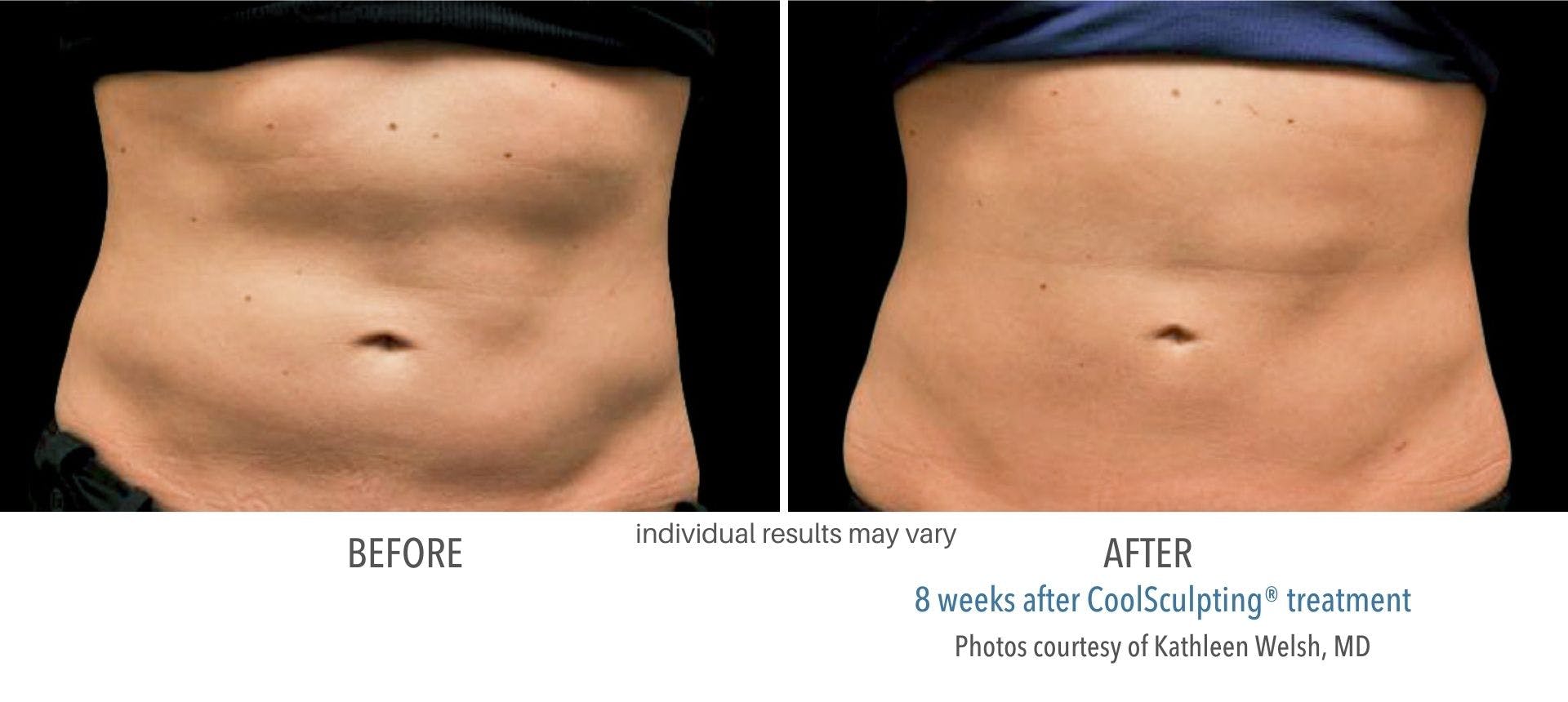 Coolsculpting results before and after treatment in Chicago.