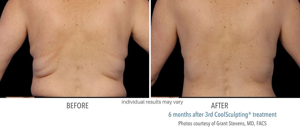 coolsculpting back fat