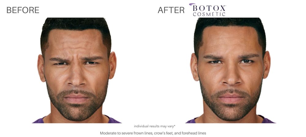 botox_before_and_after_Chicago_3