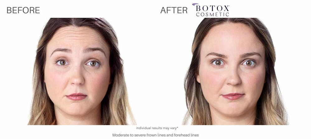 botox_before_and_after_Chicago_1