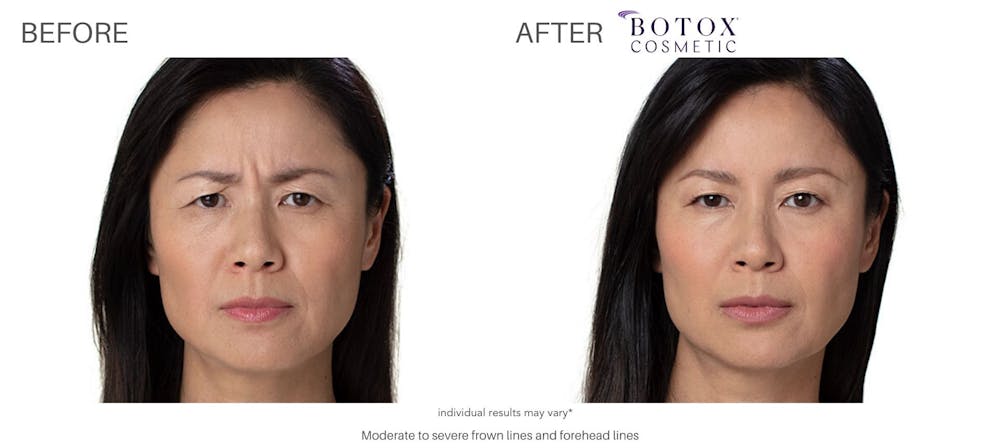 botox_before_and_after_Chicago_2