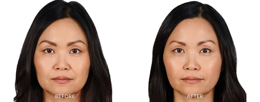 juvederm before after treatment concierge medspa (5)