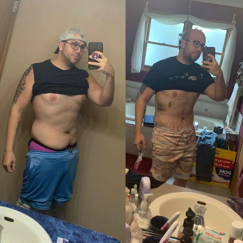 Nico's journey with tummy tuck plastic surgery showing his before and after results.