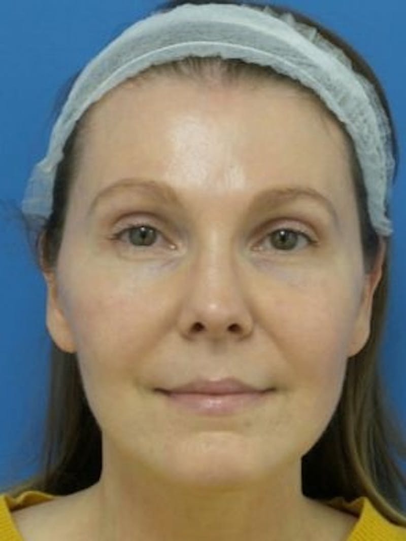 Brow Lift Before & After Gallery - Patient 923545 - Image 2