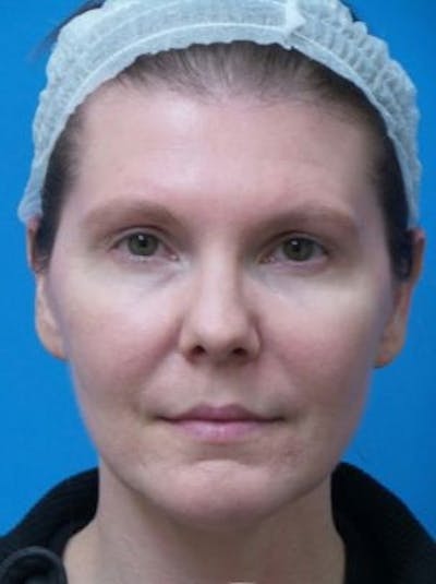 Brow Lift Before & After Gallery - Patient 923545 - Image 1