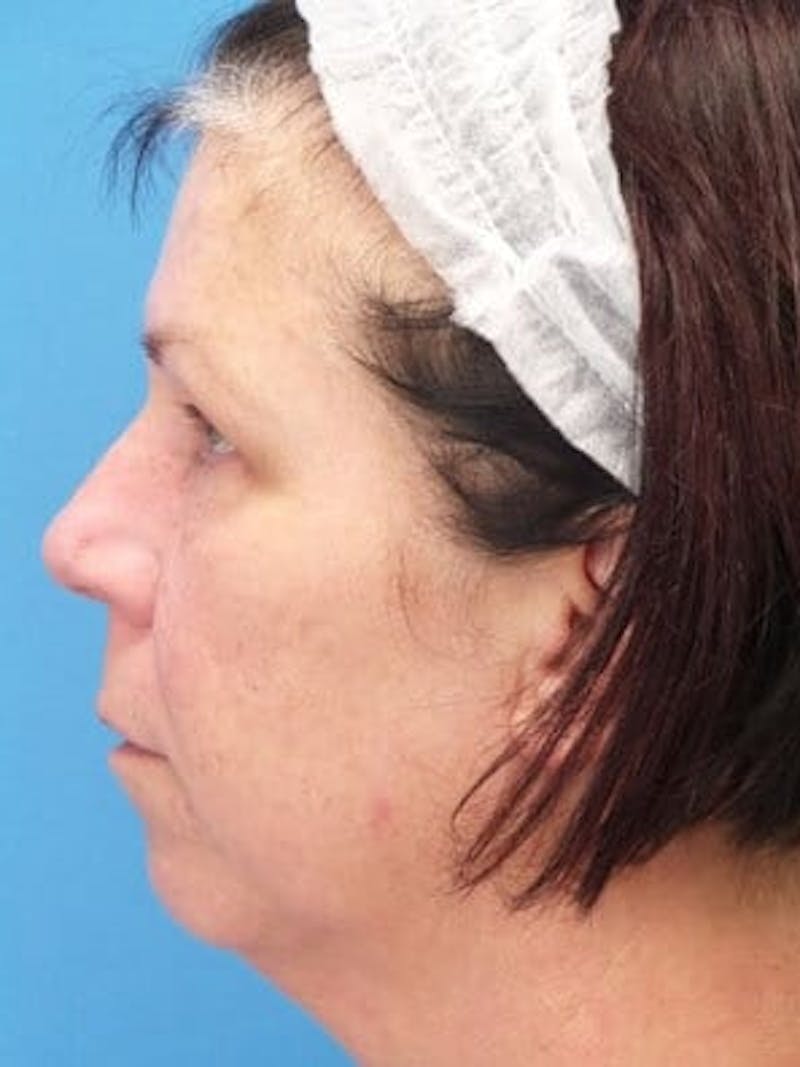 Brow Lift Before & After Gallery - Patient 312112 - Image 3