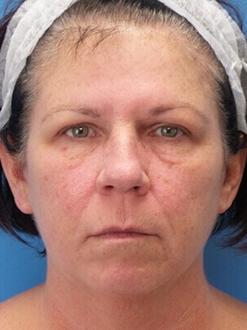 Brow Lift Before & After Gallery - Patient 312112 - Image 1