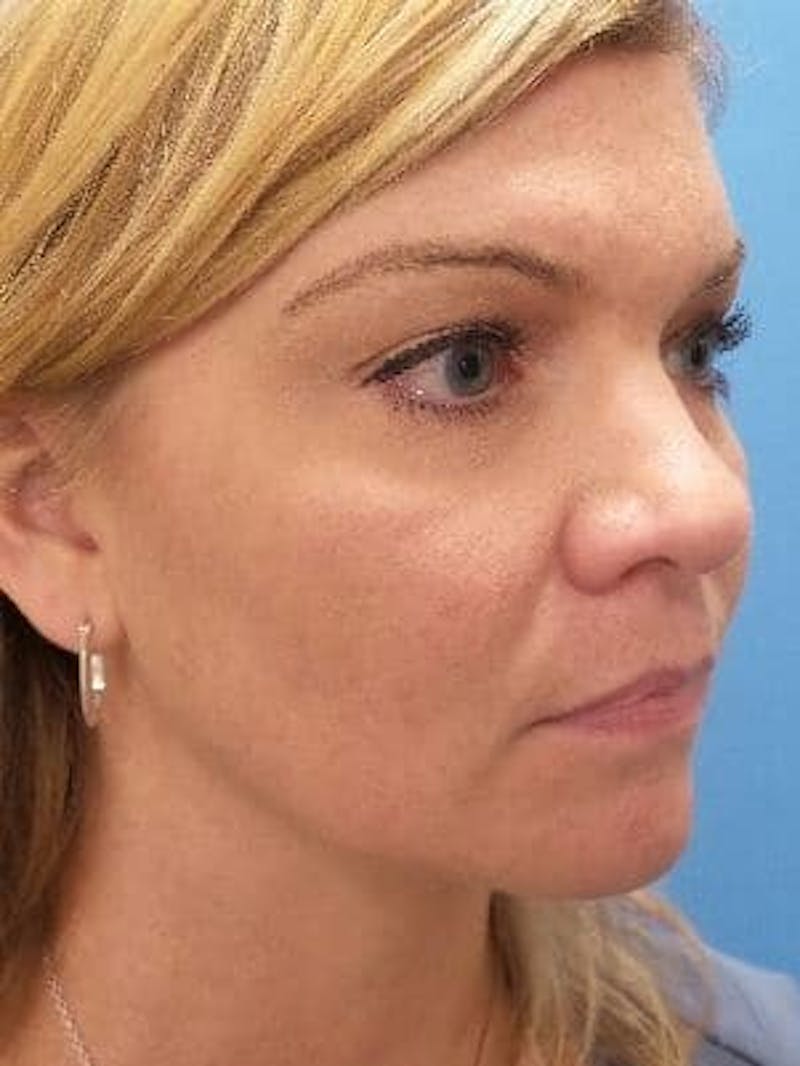 Brow Lift Before & After Gallery - Patient 140433 - Image 6