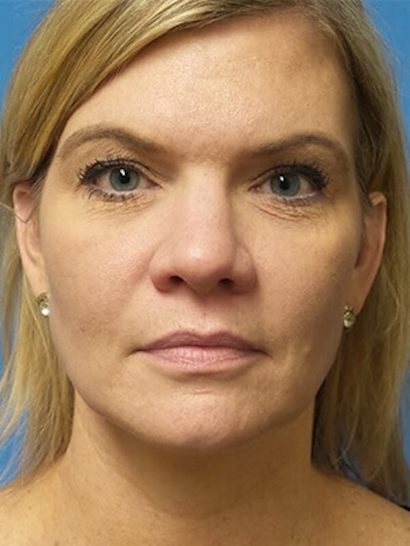 Brow Lift Before & After Gallery - Patient 140433 - Image 1