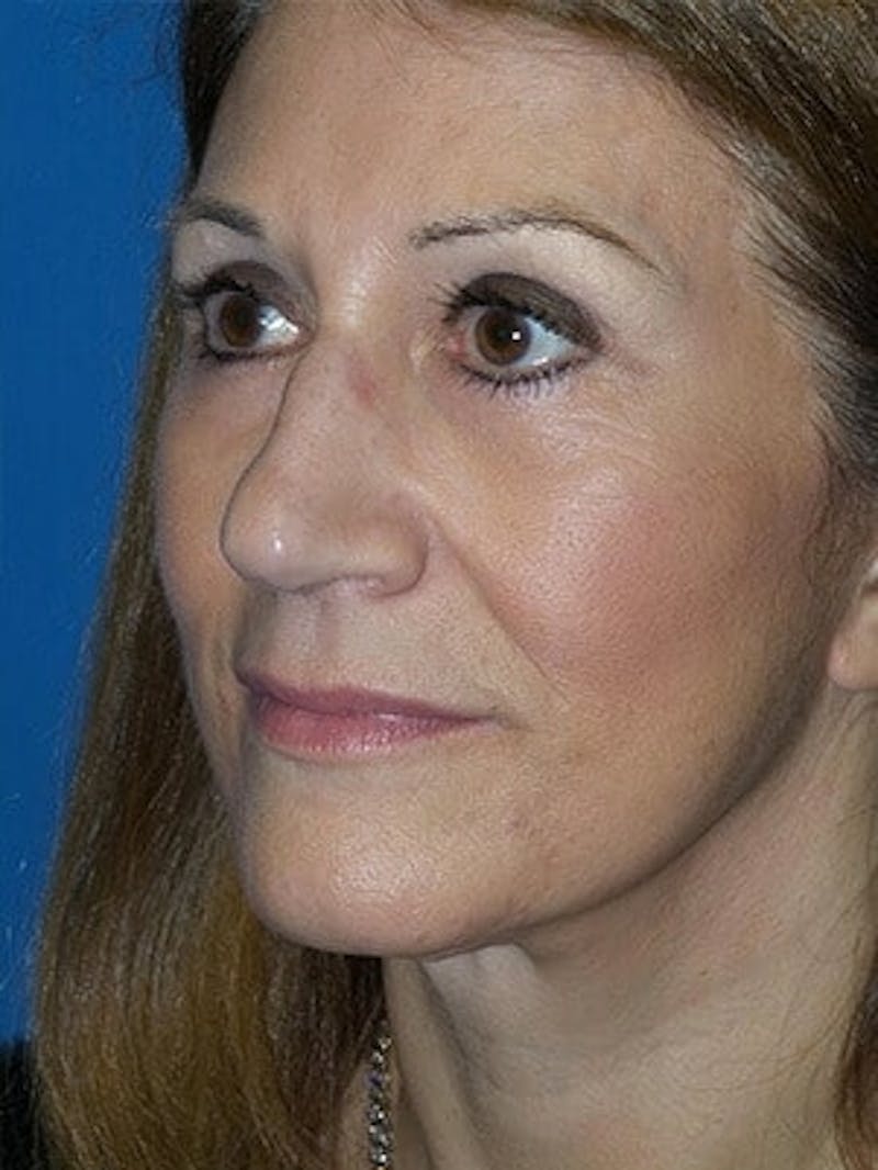 Brow Lift Before & After Gallery - Patient 246582 - Image 4