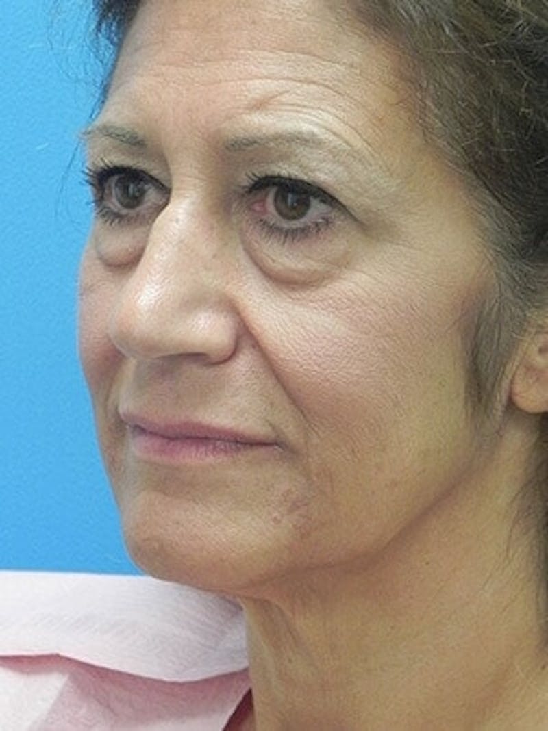 Brow Lift Before & After Gallery - Patient 246582 - Image 3