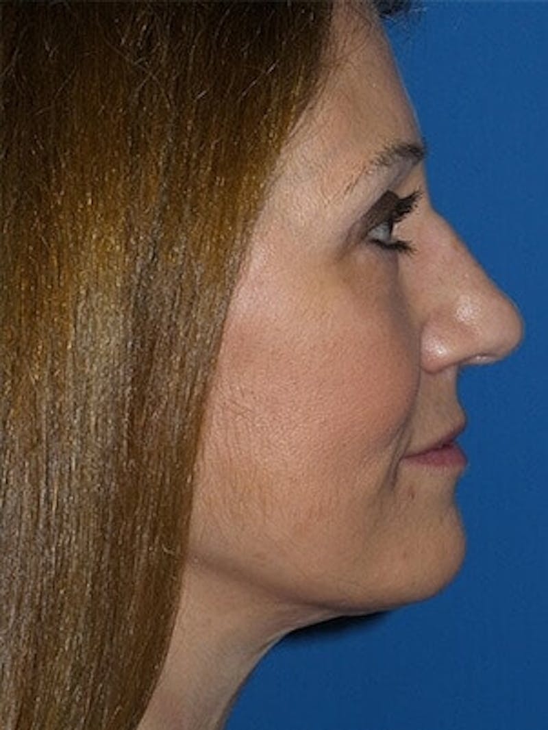 Brow Lift Before & After Gallery - Patient 246582 - Image 6