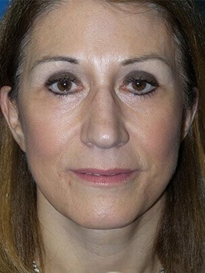 Brow Lift Before & After Gallery - Patient 246582 - Image 2
