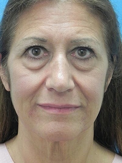 Brow Lift Before & After Gallery - Patient 246582 - Image 1