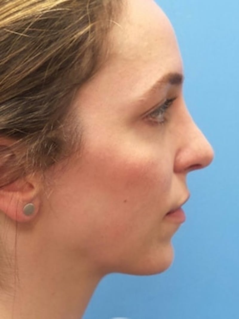 Brow Lift Before & After Gallery - Patient 339774 - Image 4