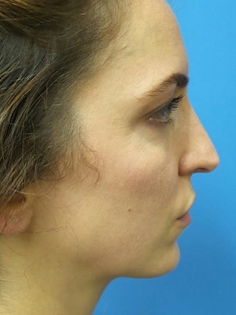 Brow Lift Before & After Gallery - Patient 339774 - Image 3