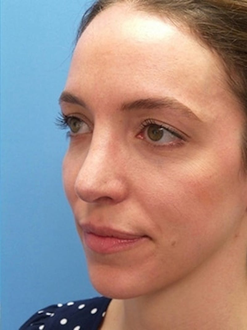 Brow Lift Before & After Gallery - Patient 339774 - Image 6