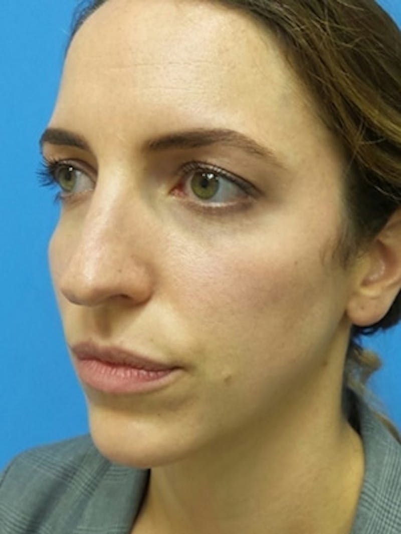 Brow Lift Before & After Gallery - Patient 339774 - Image 5