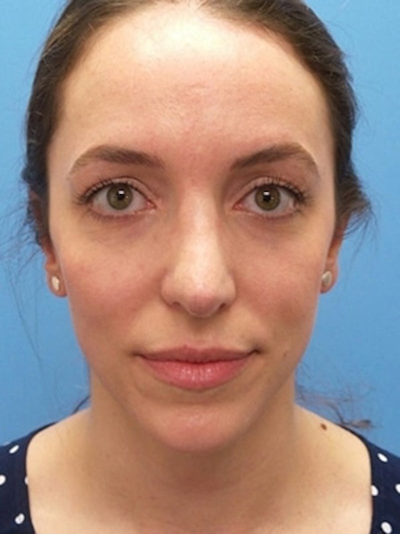 Brow Lift Before & After Gallery - Patient 339774 - Image 2