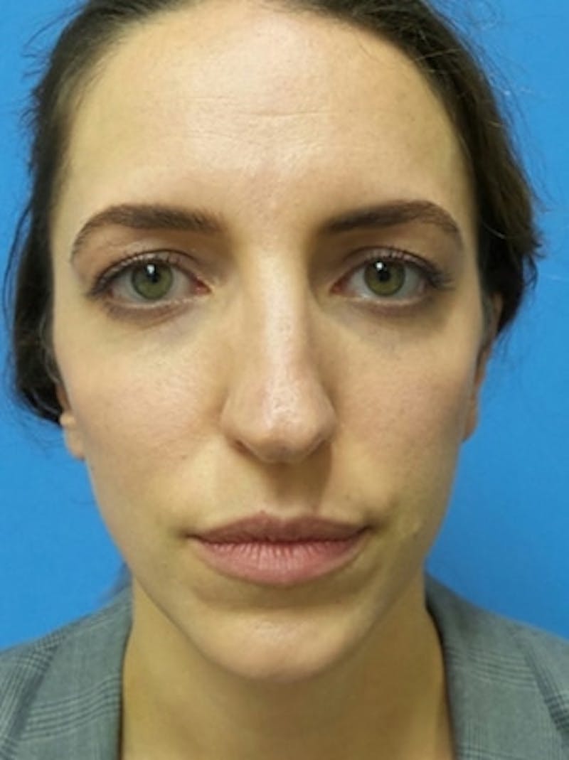 Brow Lift Before & After Gallery - Patient 339774 - Image 1