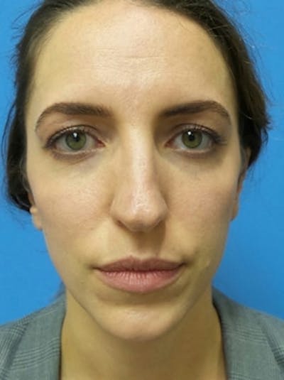 Brow Lift Before & After Gallery - Patient 339774 - Image 1