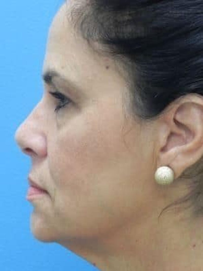 Brow Lift Before & After Gallery - Patient 271559 - Image 3