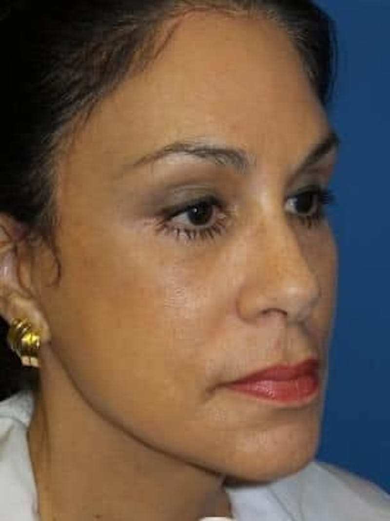 Brow Lift Before & After Gallery - Patient 271559 - Image 6