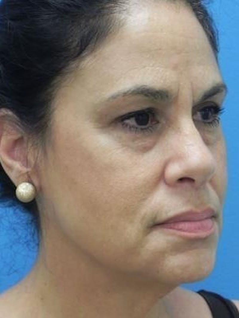 Brow Lift Before & After Gallery - Patient 271559 - Image 5